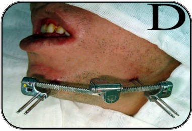 Extra-oral MultiDirectional Distractor: A Multi Uses Distractor7