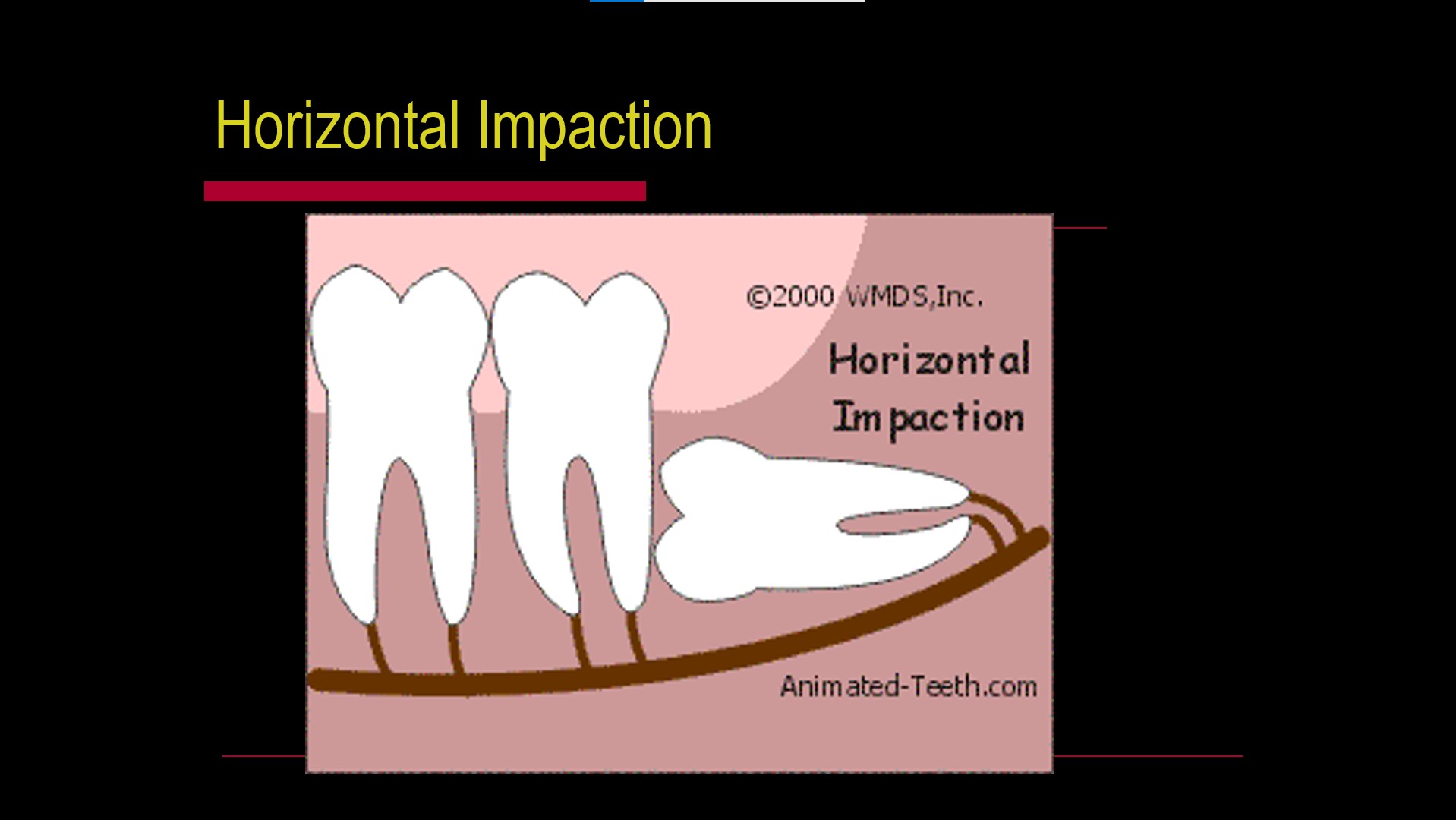 Impacted teeth2